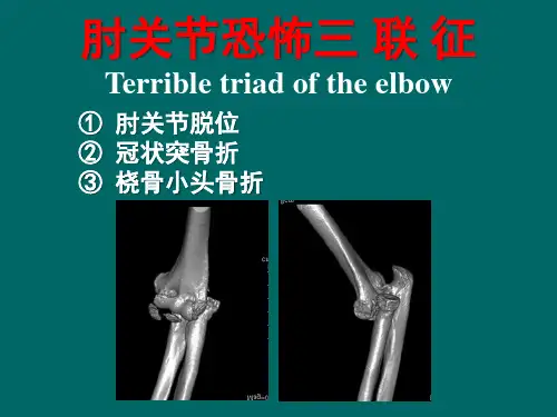 肘恐怖三联征4