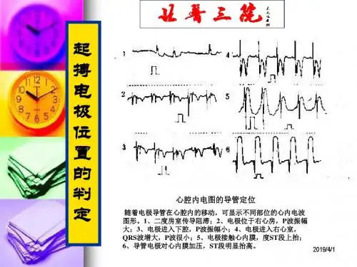 起搏心电图识别课件