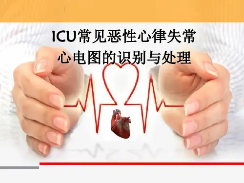 ICU常见恶性心律失常心电图的识别与处理