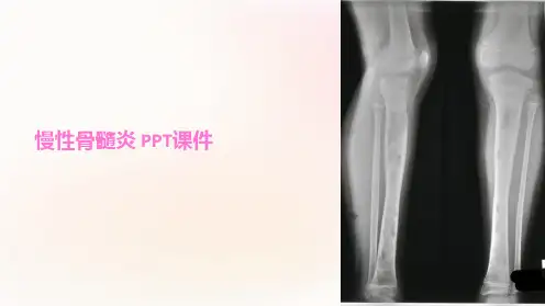 《慢性骨髓炎》课件