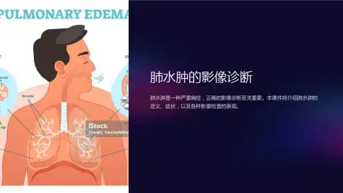 肺水肿的影像诊断课件