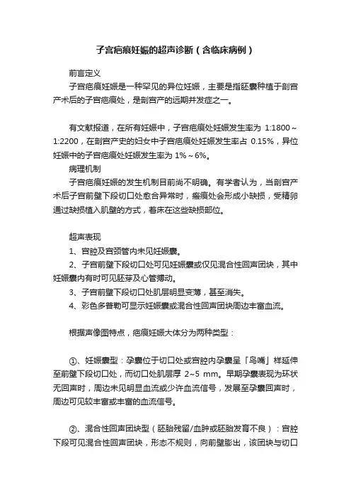 子宫疤痕妊娠的超声诊断（含临床病例）