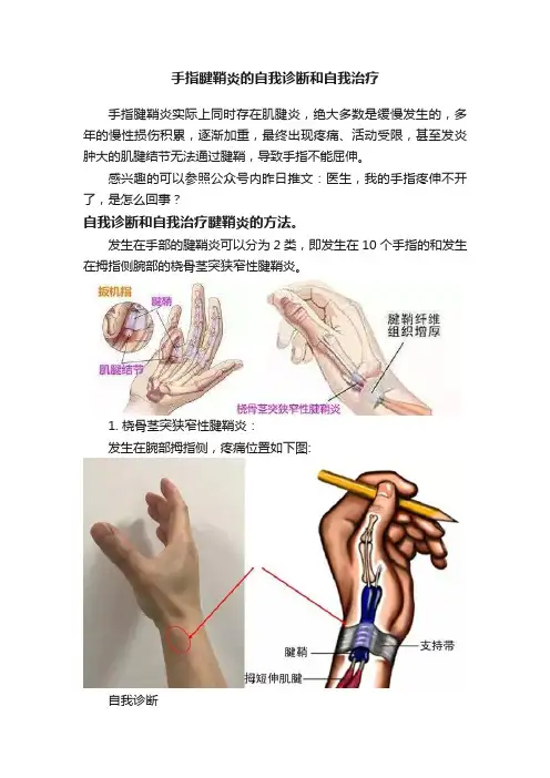 手指腱鞘炎的自我诊断和自我治疗
