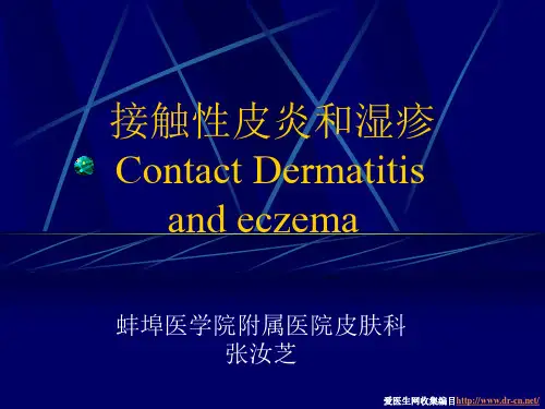 接触性皮炎和湿疹