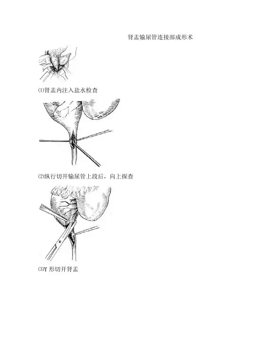 肾盂成形术