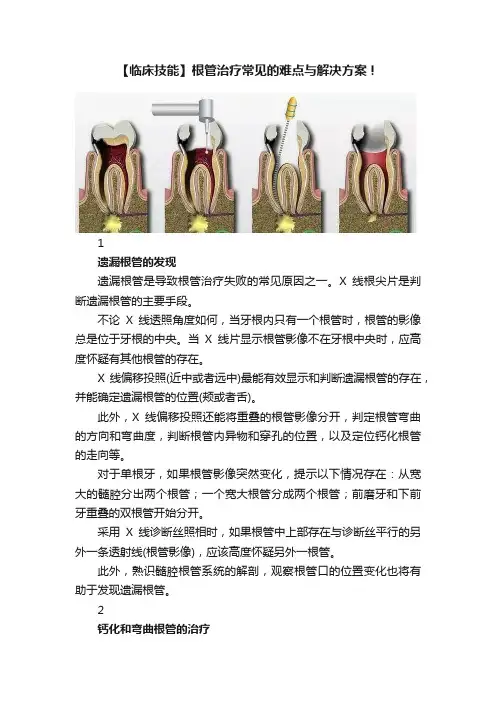 【临床技能】根管治疗常见的难点与解决方案！