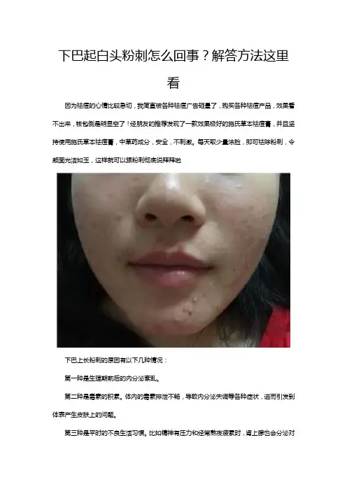 下巴起白头粉刺怎么回事？解答方法这里看