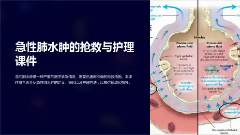 急性肺水肿的抢救与护理课件