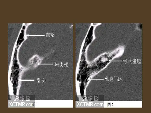 耳部最详细CT解剖