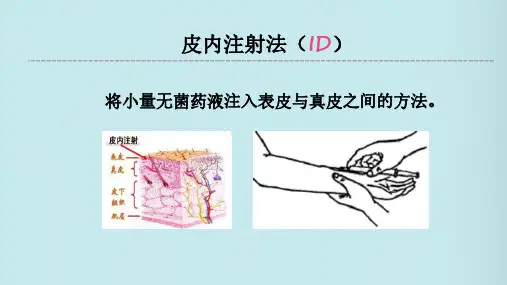 皮内注射法