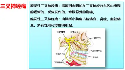 三叉神经痛病人的护理PPT课件