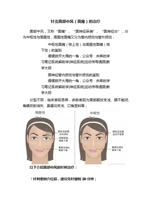 针灸面部中风（面瘫）的治疗