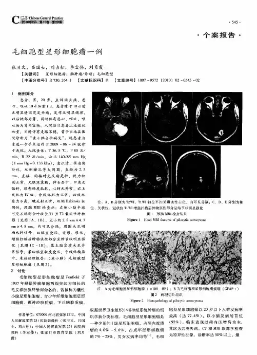 毛细胞型星形细胞瘤一例