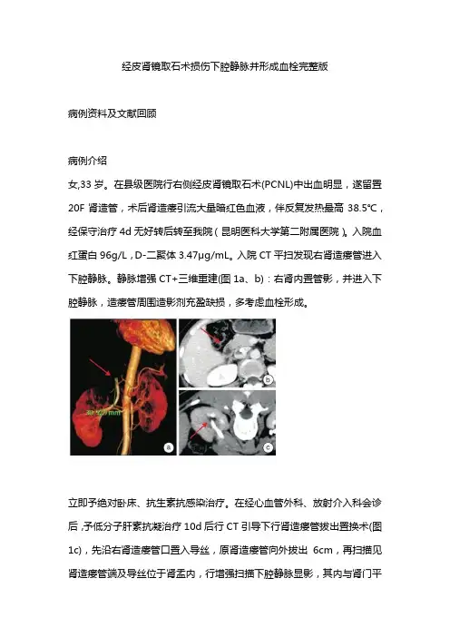 经皮肾镜取石术损伤下腔静脉并形成血栓完整版