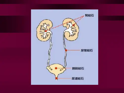 医学课件肾输尿管膀胱结石