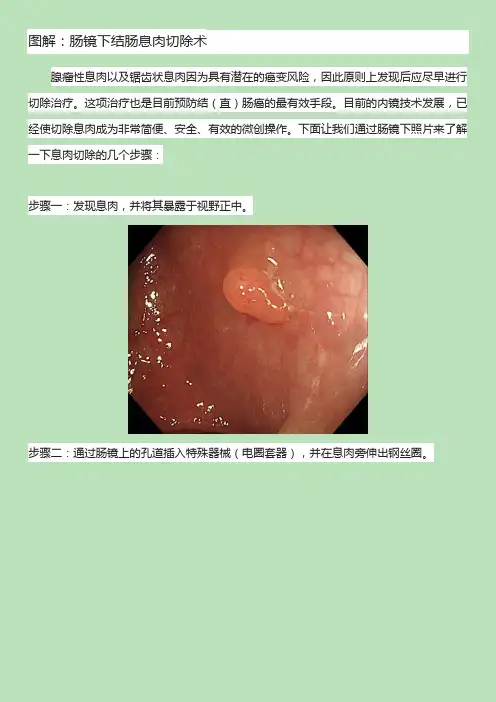 图解：肠镜下结肠息肉切除术
