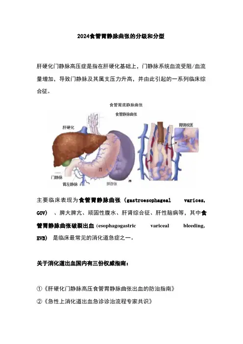 2024食管胃静脉曲张的分级和分型 