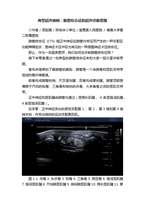 典型超声病例：腕管综合征的超声诊断思路