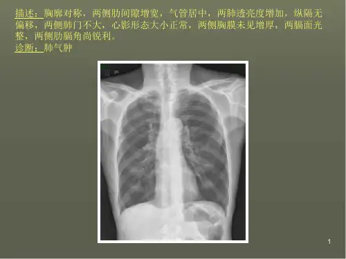 (培训课件)常见40张X片读片及诊断PPT幻灯片