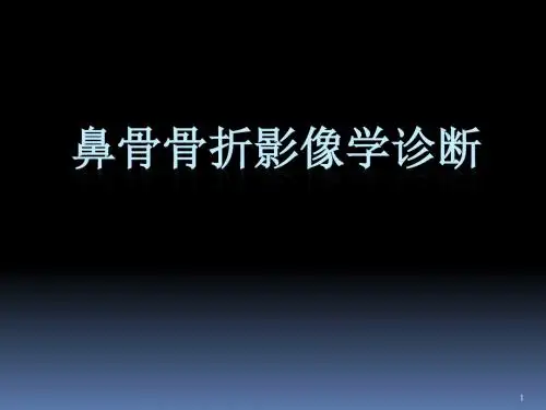 (医学PPT课件)鼻骨骨折影像学诊断与鉴别(精品)
