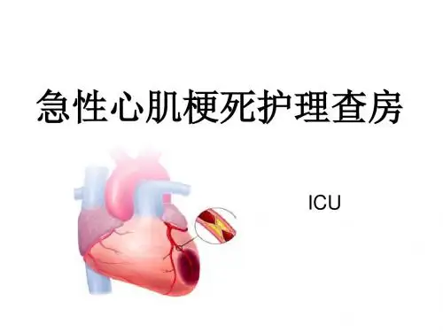 急性心肌梗死护理查房(ICU)