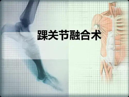 踝关节融合术