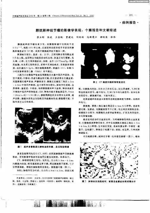膀胱副神经节瘤的影像学表现：个案报告和文献综述