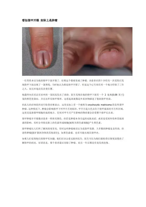 看似指甲开裂 实际上是肿瘤