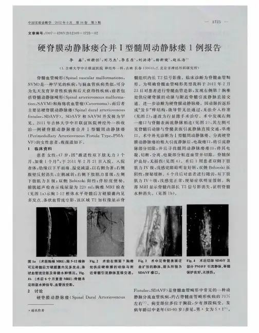 硬脊膜动静脉瘘合并Ⅰ型髓周动静脉瘘1例报告