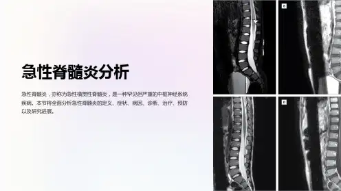 急性脊髓炎分析