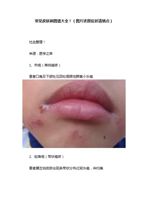 常见皮肤病图谱大全！（图片还原症状请慎点）