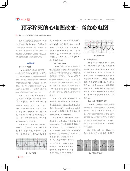 预示猝死的心电图改变：高危心电图