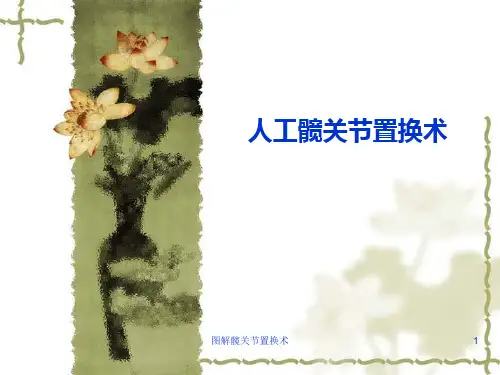 图解髋关节置换术 ppt课件