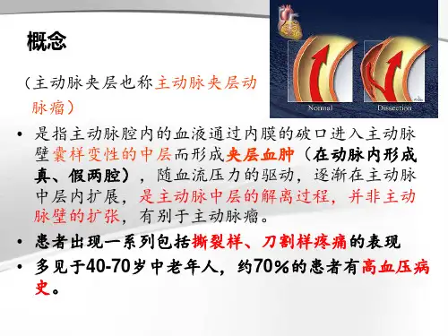 主动脉夹层患者的护理查房2-PPT文档