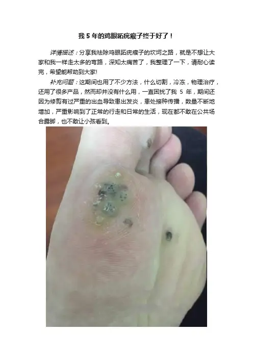 我5年的鸡眼跖疣瘊子终于好了！