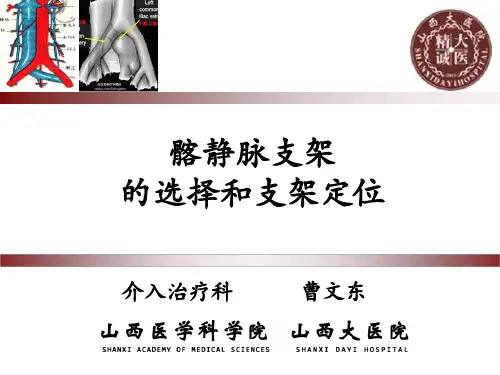 髂静脉支架的选择和支架定位