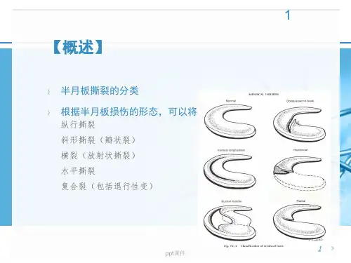 半月板撕裂的治疗ppt课件