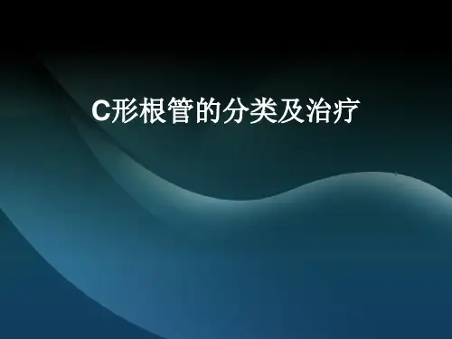 C形根管的分类及治疗
