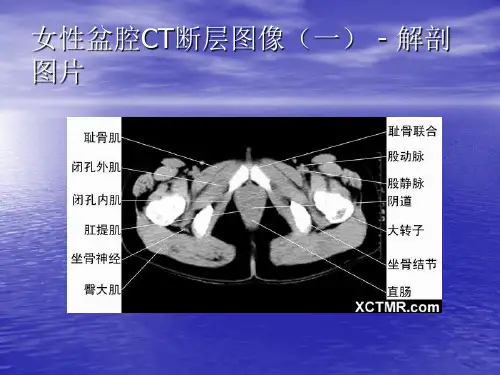 盆腔CT诊断