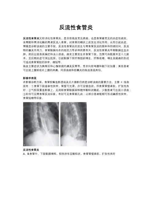反流性食管炎