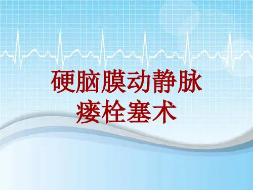 手术讲解模板：硬脑膜动静脉瘘栓塞术