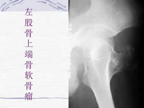 骨肿瘤X线病例图谱A