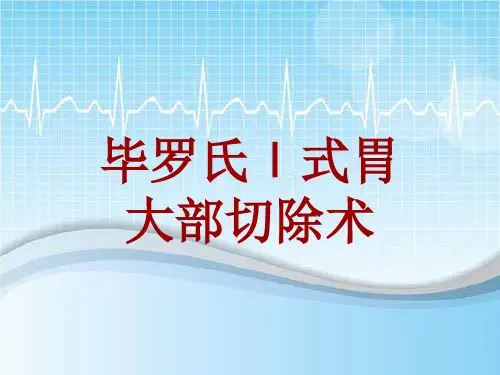 手术讲解模板：毕罗氏Ⅰ式胃大部切除术