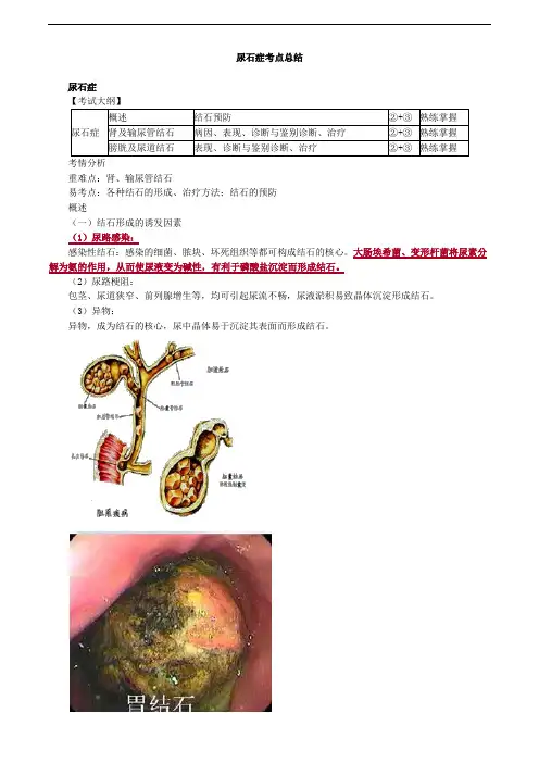 尿石症考点总结