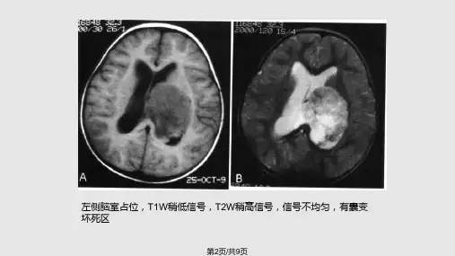 侧脑室占位影像诊断与鉴别