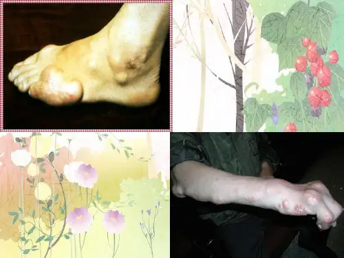 痛风病人的护理PPT培训课件