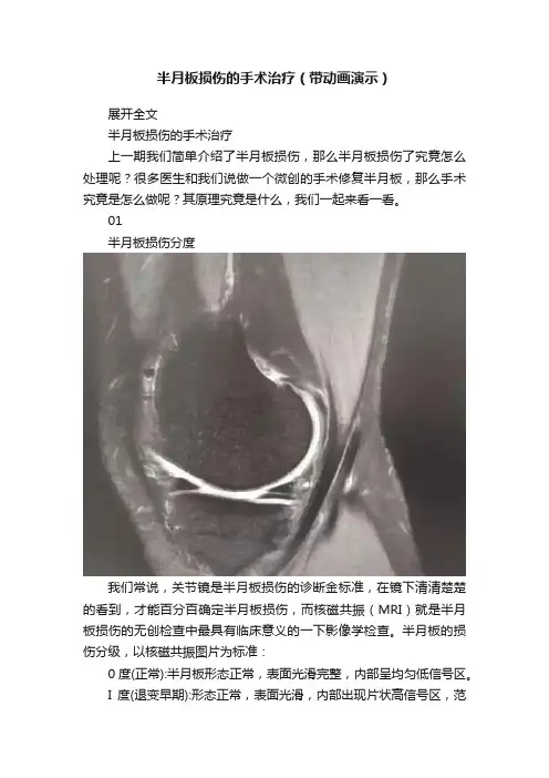 半月板损伤的手术治疗（带动画演示）