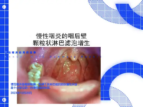 慢性咽炎的用药指导