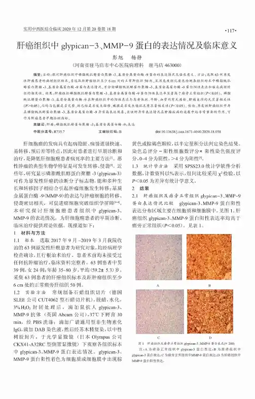 肝癌组织中glypican-3、MMP-9蛋白的表达情况及临床意义