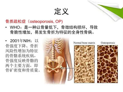 原发性骨质疏松症诊治指南精简版ppt课件